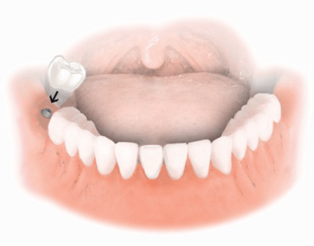 Dental Implant Solutions Leesburg, VA