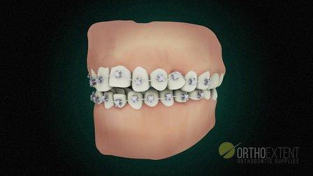 OrthoExtent